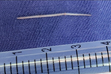 Chữa mẹo sau khi hóc xương cá, người phụ nữ nhập viện