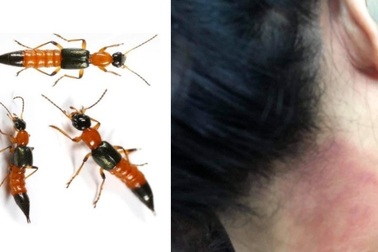 Tăng đột biến số người bị kiến ba khoang đốt