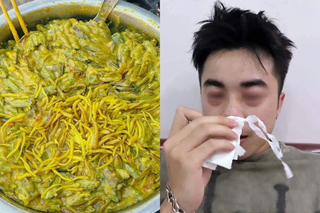 Mặt sưng húp khi ăn đặc sản giá bể Hải Phòng: Bác sĩ cảnh báo - 1 Mặt sưng húp khi ăn đặc sản giá bể Hải Phòng: Bác sĩ cảnh báo - 1