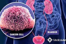 Phát hiện mới về mối liên quan giữa ung thư bàng quang và hút thuốc lá