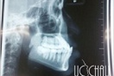 Chỉnh răng hô móm một lần duy nhất tại Thẩm mỹ Úc Châu