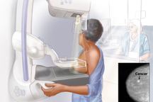 Có những cách nào để chẩn đoán ung thư vú?