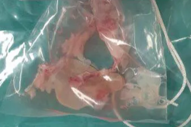 Hãi hùng ổ sán khổng lồ trú ngụ trong não người đàn ông