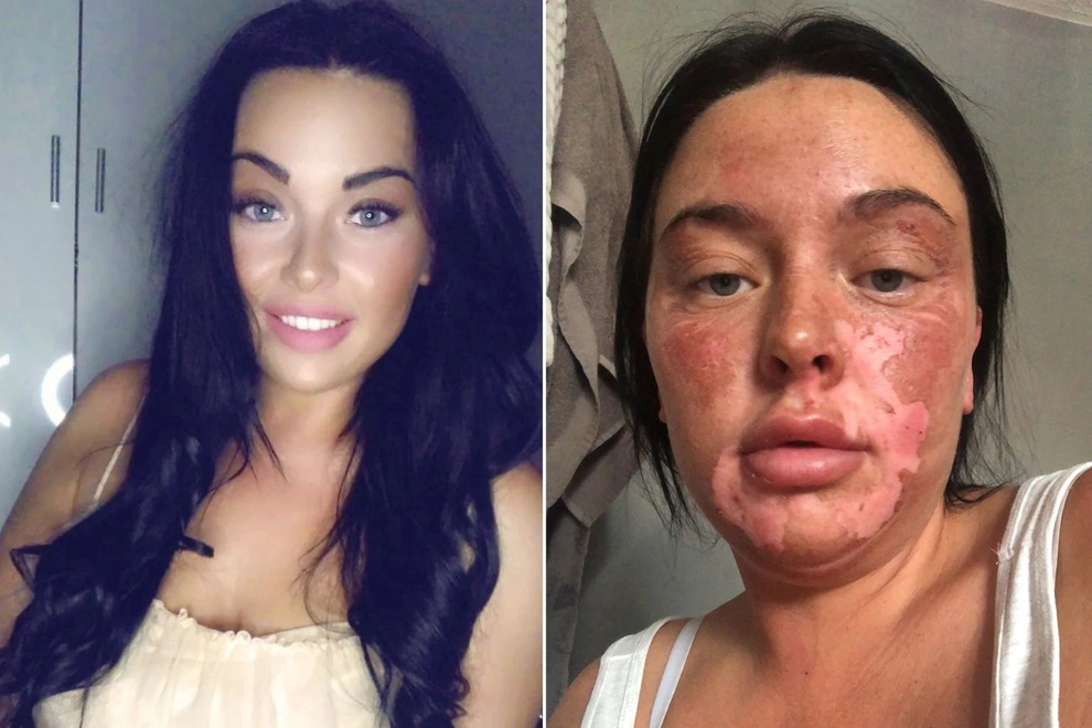 Chantelle Conway cũng đã bị bỏng mặt nghiêm trọng vì học theo mẹo làm trứng chần trên TikTok (Ảnh: TikTok). Chantelle Conway cũng đã bị bỏng mặt nghiêm trọng vì học theo mẹo làm trứng chần trên TikTok (Ảnh: TikTok).