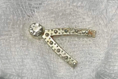 Cháu bé một tuổi nuốt kẹp tóc bằng sắt, mắc kẹt trong thực quản suốt 3 ngày