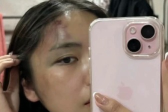 Công an điều tra vụ người phụ nữ tố bị chồng hành hung tại chung cư