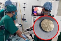 Bé gái 16 tháng tuổi cấp cứu vì nuốt viên pin trong đồ chơi