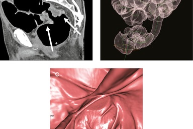 Trung Quốc phát triển mô hình dự đoán ung thư trực tràng