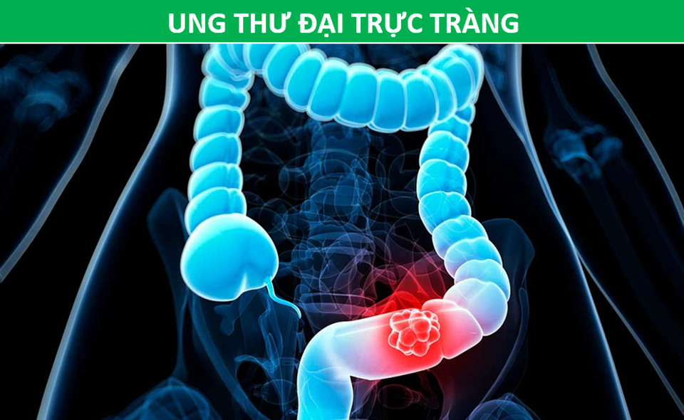 Những phương pháp tầm soát ung thư giúp bạn chủ động trước bệnh tật - 5 Những phương pháp tầm soát ung thư giúp bạn chủ động trước bệnh tật - 5