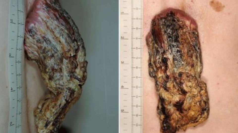 Người đàn ông “mọc sừng” dài 14 cm trên lưng vì…ung thư da - 2 Người đàn ông “mọc sừng” dài 14 cm trên lưng vì…ung thư da - 2