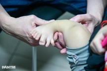 Căn bệnh hiếm ở trẻ gây khó vận động, mất nhiều năm điều trị