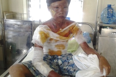 Nổ bình gas mini, một học sinh bỏng nặng