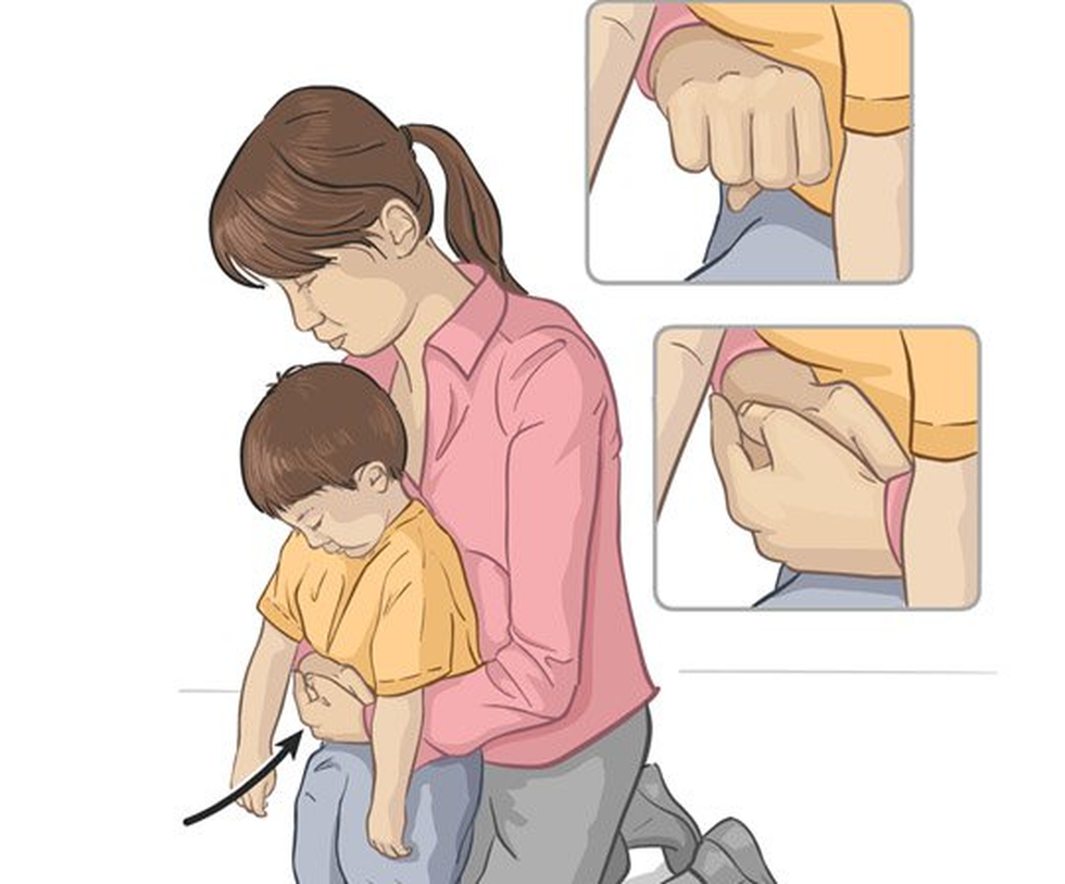 Tư thế thực hiện động tác Heimlich với trẻ trên 2 tuổi, khi trẻ còn tỉnh táo (Ảnh minh họa: Vinmec). Tư thế thực hiện động tác Heimlich với trẻ trên 2 tuổi, khi trẻ còn tỉnh táo (Ảnh minh họa: Vinmec).