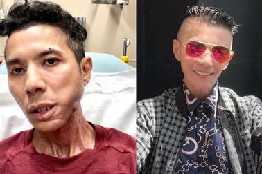 Kasim Hoàng Vũ sau 5 ngày cấp cứu: Không thể ăn, uống giảm đau mỗi ngày