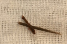 Bỗng dưng đau bụng, chàng trai phát hoảng vì dị vật "chọc" thủng đại tràng