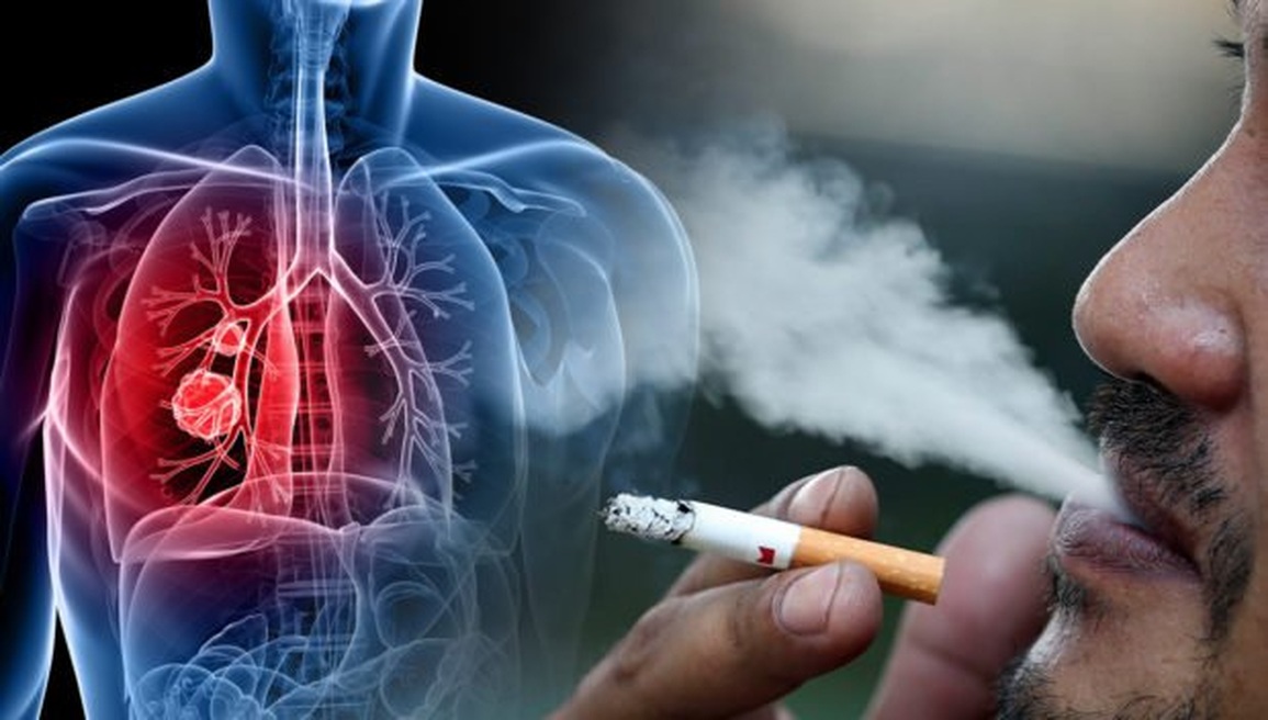 Nguy cơ ung thư phổi tăng cao khi thuộc một trong những nhóm này - 1 Nguy cơ ung thư phổi tăng cao khi thuộc một trong những nhóm này - 1