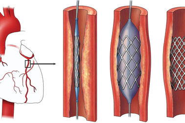 Đặt stent mạch vành được bao lâu? Cách chăm sóc kéo dài hiệu quả