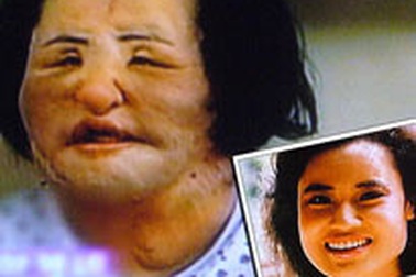 "Thảm họa" phẫu thuật thẩm mỹ của một phụ nữ Hàn Quốc