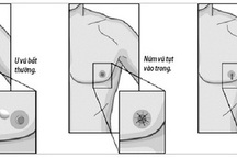Các dấu hiệu báo động ung thư vú ở nam giới