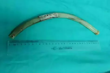 Mắc kẹt ống nhựa dài 30cm, dày 1,9cm trong dạ dày, người phụ nữ bối rối đến viện