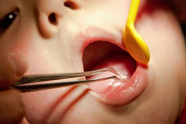 Bé gái suýt mất mạng vì cô giáo cố lôi chiếc thìa hóc ở cổ họng