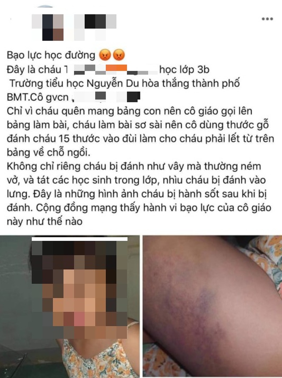 Nữ sinh bị giáo viên đánh bầm tím đùi tới mức phải lết từ bảng về chỗ ngồi? - 3 Nữ sinh bị giáo viên đánh bầm tím đùi tới mức phải lết từ bảng về chỗ ngồi? - 3