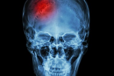 Phương pháp điều trị mới đẩy lùi triệu chứng đột quỵ