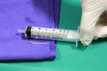 Người phụ nữ thủng ruột vì thói quen sau khi ăn của nhiều người Việt