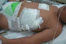 Cứu sống trẻ ngã từ tầng 2, rách màng phổi