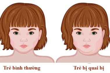 7 dấu hiệu của bệnh quai bị