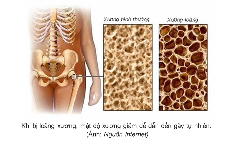 Đau ở vùng lưng - dấu hiệu có thể bạn cần đi khám loãng xương - 2
