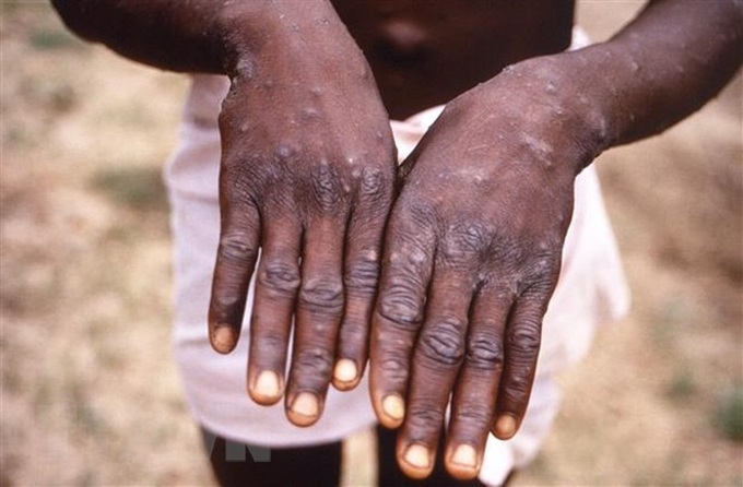 Bệnh nhân mắc đậu mùa khỉ tại Cộng hòa Dân chủ Congo. (Ảnh: AFP/TTXVN).

