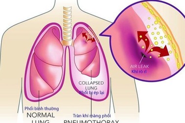 Tràn dịch màng phổi - biến chứng của nhiều bệnh