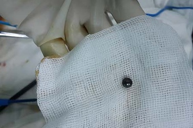 Suýt tử vong vì viên bi xe đạp