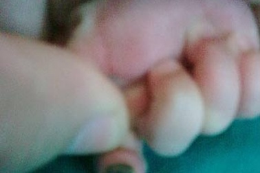 Trẻ sơ sinh bị hoại tử đầu ngón tay do bao tay