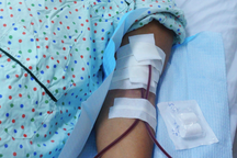 Chuyên gia nói gì về việc "lọc máu ngừa đột quỵ"?