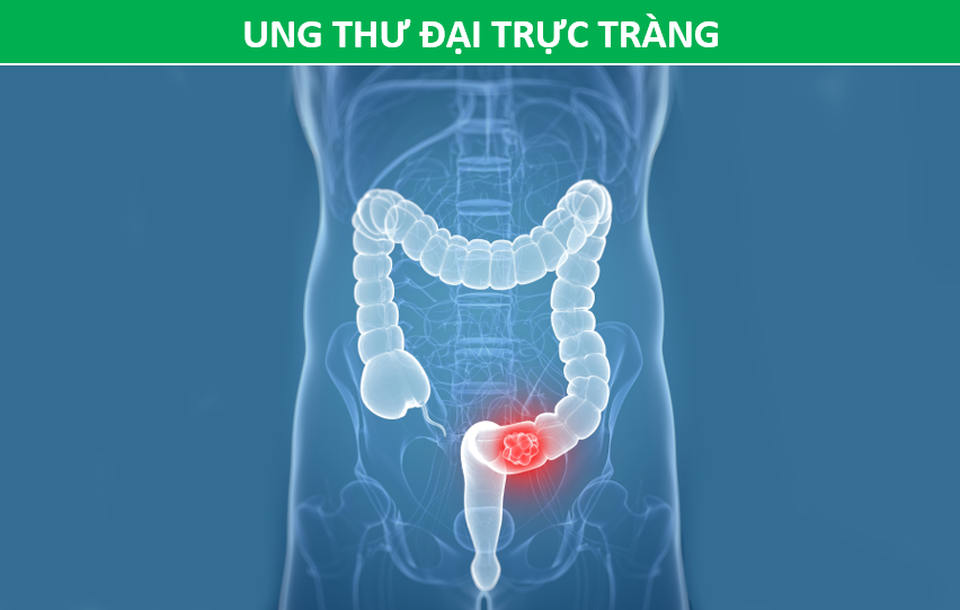 3 loại ung thư có tính di truyền cao, cần đề phòng nếu người thân mắc phải - 2