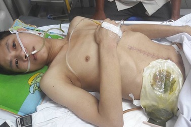 Bị máy vận thăng chèn nửa người, tính mạng chàng trai tuổi 20 nguy kịch