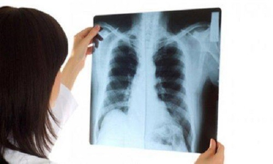 Người phụ nữ ung thư phổi di căn dù chỉ có dấu hiệu khó thở, tức ngực - 1 Người phụ nữ ung thư phổi di căn dù chỉ có dấu hiệu khó thở, tức ngực - 1