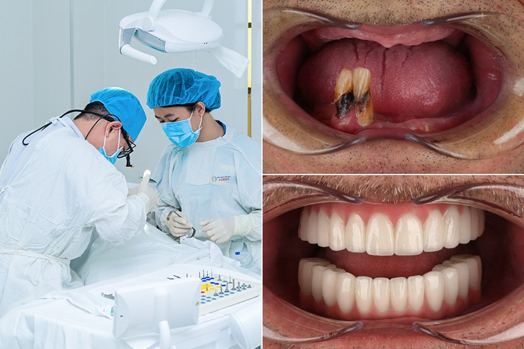 Rụng răng: Dấu hiệu của bệnh lý cần lưu ý và cách khắc phục - 3 Rụng răng: Dấu hiệu của bệnh lý cần lưu ý và cách khắc phục - 3