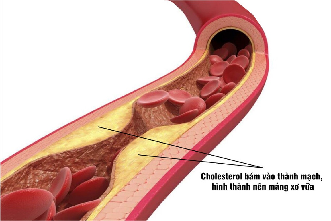 Hiểu đúng về cholesterol để phòng bệnh mỡ máu cao - 1 Hiểu đúng về cholesterol để phòng bệnh mỡ máu cao - 1