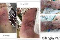 Từ vết đốt nhỏ khi đi tắm biển, người đàn ông thập tử nhất sinh