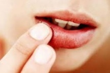 Điều trị ung thư môi như thế nào?