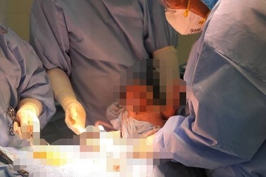 Mổ lấy thai thành công cho sản phụ từ vùng dịch trở về chưa qua cách ly