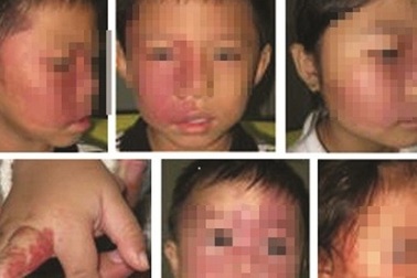 U máu có nguy hiểm đến tính mạng?