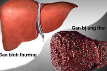 Cô gái 32 tuổi sốc khi phát hiện ung thư gan sau khi có biểu hiện mẩn ngứa, khô mắt