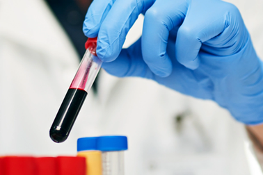 Dấu hiệu trong máu báo trước việc sa sút trí tuệ hàng chục năm sau