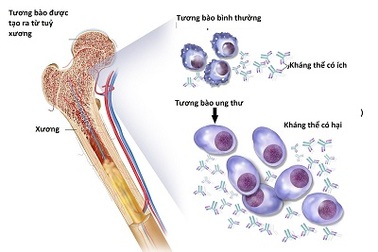 Liệu pháp gen dựa trên tế bào đầu tiên trị bệnh đa u tủy
