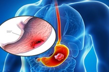 Chỉ số CA 19-9 tăng cao có phải đã mắc ung thư tụy?