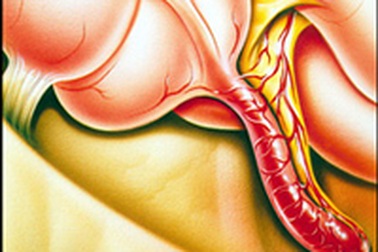 Nguy cơ viêm ruột thừa do môi trường ô nhiễm